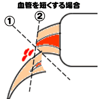 血管をカットする爪切り